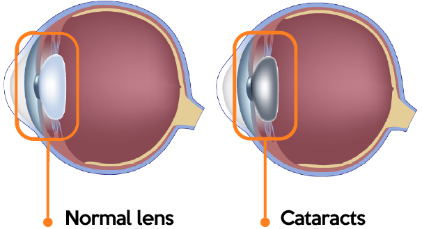 Normal eye ball vs cataract