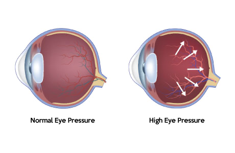 excessive internal eye pressure