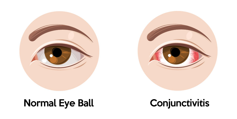 what is Conjunctivitis